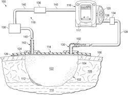 WOUND DEBRIDEMENT BY IRRIGATION WITH ULTRASONICALLY ACTIVATED MICROBUBBLES