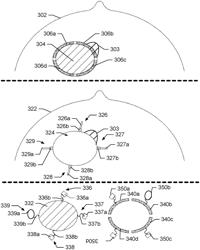 METHOD AND SYSTEM FOR DELINEATING AND LINKING/CORRELATING OPPOSING MARGINS OF A PATHOLOGY SPECIMEN AND IMMEDIATELY ADJACENT REMAINING IN VIVO MARGINS