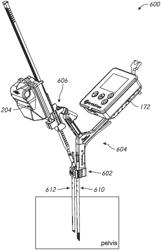 HIP REPLACEMENT NAVIGATION SYSTEMS AND METHODS