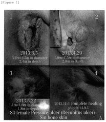 Therapeutic material for skin ulcer