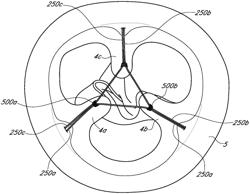 VALVE HOLDER ASSEMBLY WITH SUTURE LOOPING PROTECTION