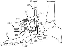 Intramedullary nail alignment guides, fixation guides, devices, systems, and methods of use