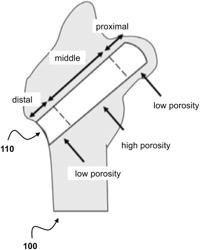 Customized load-bearing and bioactive functionally-graded implant for treatment of osteonecrosis