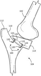 TIBIAL PLATEAU LEVELING OSTEOTOMY SYSTEMS AND METHODS