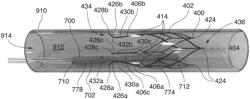 Mammalian body conduit intralumenal device and lumen wall anchor assembly, components thereof and methods of implantation and explanation thereof