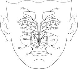 Method of treating deviated nasal septum, enlarged nasal turbinate, or mucosal hypertrophy