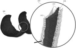 SYSTEM AND METHOD FOR ARTICULAR CARTILAGE THICKNESS MAPPING AND LESION QUANTIFICATION