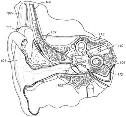 Neural Network Audio Scene Classifier for Hearing Implants