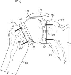 STEMLESS SHOULDER IMPLANT