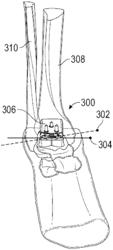 DYNAMIC JOINT ANALYSIS FOR JOINT REPLACEMENT