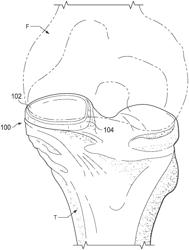 FLOATING JOINT REPLACEMENT DEVICE WITH SUPPORTIVE SIDEWALL