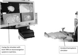 RESECTIVE EPILEPSY SURGERY BRAIN SIMULATOR