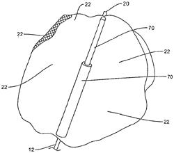 Coated endovascular intrasaccular occlusion device