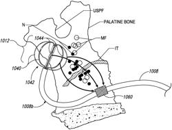 Devices for therapeutic nasal neuromodulation and associated methods and systems