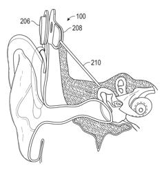 IN-EAR BALANCE DETECTION SYSTEM