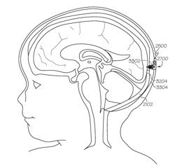 SURGICAL METHOD, DEVICE, SYSTEM AND KIT FOR THE TREATMENT OF HYDROCEPHALUS