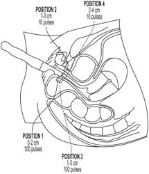 METHODS FOR TREATING URINARY STRESS INCONTINENCE