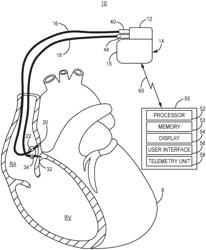 Ventricular sensing control in a cardiac pacing system