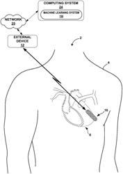 VISUALIZATION OF ARRHYTHMIA DETECTION BY MACHINE LEARNING