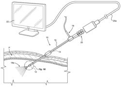 Internal Cleaning of Laparoscopic Lens With Wiper