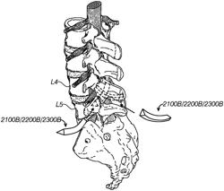 SYSTEMS, DEVICES, AND METHODS FOR JOINT FUSION