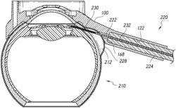 AB EXTERNO INTRAOCULAR SHUNT PLACEMENT