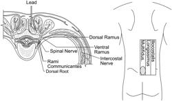 Systems and methods related to the treatment of back pain