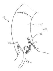 ARTIFICIAL BLOOD VESSEL COMPLEX