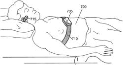 Device to detect and treat apneas and hypopnea