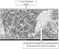 Therapeutic agent for solid cancer