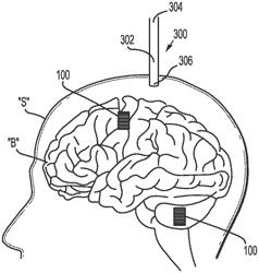 LIDAR IMPLANTABLE BIOSENSOR FOR IMAGING BIOLOGICAL TISSUE