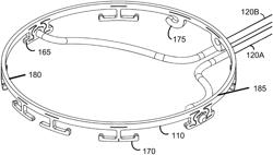 SURGICAL RING DESIGN WITH VARYING WALL THICKNESS AND CONSISTENT CROSS-SECTIONAL AREA