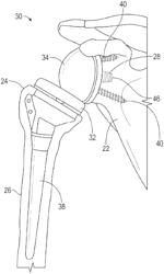 GLENOID SYSTEM