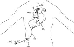 PRESSURE UNLOADING LEFT VENTRICULAR ASSIST DEVICE AND METHODS FOR ASSISTING A HUMAN HEART