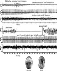 System, method and biomarkers for airway obstruction