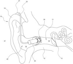 ACOUSTIC VALVE, AND HEARING DEVICE INCLUDING SUCH AN ACOUSTIC VALVE