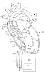 FLEXIBLE OUTFLOW CANNULA WITH SHAPED OUTLETS