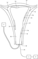 THERMAL HEATING ELEMENT FOR USE WITH ENDOMETRIAL ABLATION