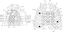 Coronary artery disease detection signal processing system and method