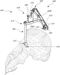 Hip replacement navigation system and method