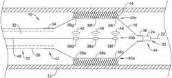 LITHOTRIPSY CATHETERS