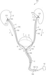 Ureteral and bladder catheters and methods of inducing negative pressure to increase renal perfusion