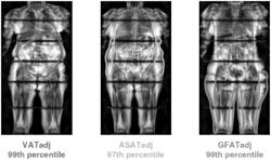 GENETIC VARIANTS ASSOCIATED WITH LOCAL FAT DEPOSITION TRAITS FOR THE TREATMENT OF HERITABLE METABOLIC DISORDERS