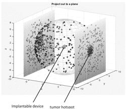 IMPLANTS USING ULTRASONIC BACKSCATTER FOR RADIATION DETECTION AND ONCOLOGY