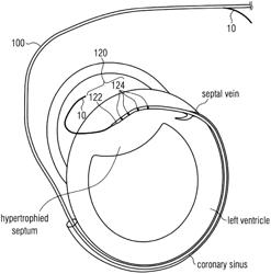 RF ABLATION CATHETER FOR TREATING HYPERTROPHIC CARDIOMYOPATHY AND METHOD OF TREATING HYPERTROPHIC CARDIOMYOPATHY BY USING SAME