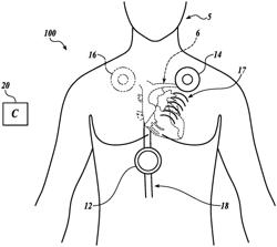 HEMODYNAMIC MONITORING SYSTEM