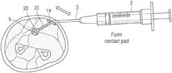 Electrode curable and moldable to contours of a target in bodily tissue and methods of manufacturing and placement and dispensers therefor