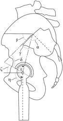 Methods and systems for targeted alignment and sagittal plane positioning for hip replacement surgery