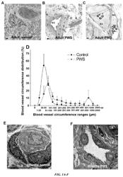 Pathogenic biomarkers and serum extracellular vesicular biomarkers associated with vascular malformation of endothelial cells, and uses thereof