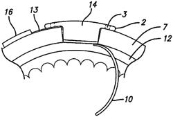 Implantable device for the brain